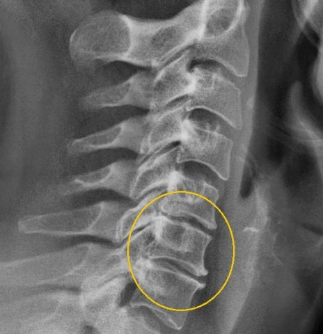 emakakaela osteokondroos